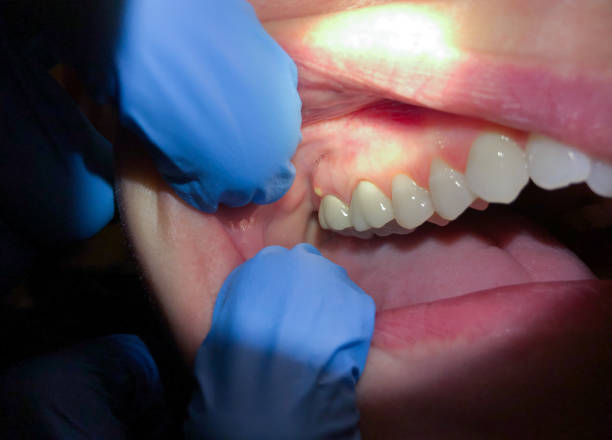 Best Emergency Dentist for Lost Fillings or Crowns in Fort Mckinley, OH